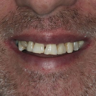 Dental Veneers - Smile 5 before